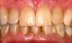 Stained and decayed teeth