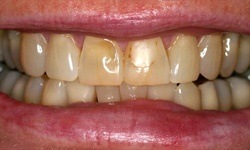 Front teeth with dark lines