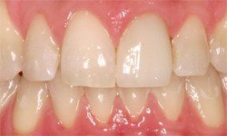 Beautiful smile with healthy gums