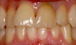 Discolored and misshapen front teeth