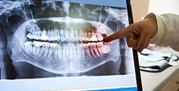 Panoramic dental x-ray on computer screen